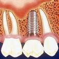Implantátumon rögzített híd, fogsor
